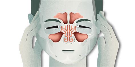 rhinosinusitis wikipedia